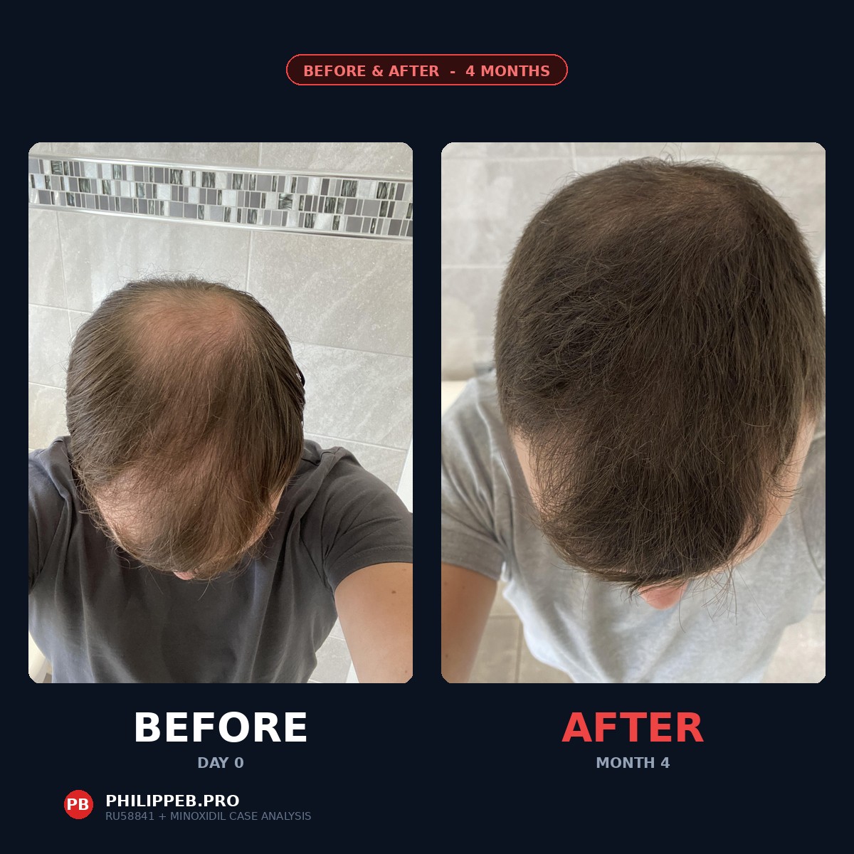 RU58841 plus minoxidil 4-month progress case article cover